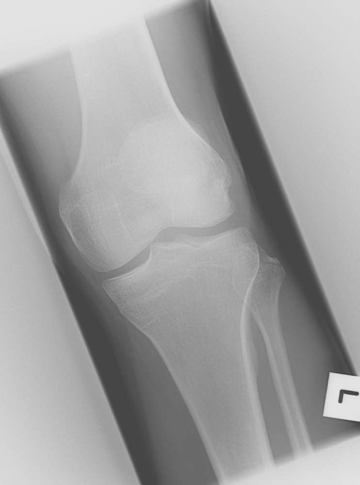 Fibular Avulsion Fracture